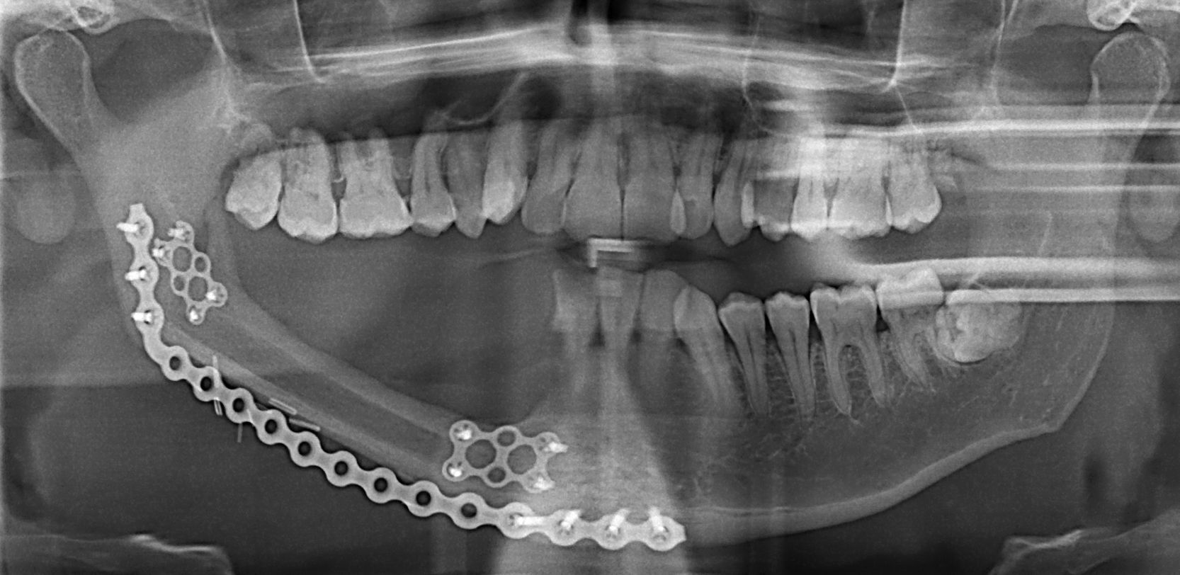 Bone reconstruction options for the Mandible