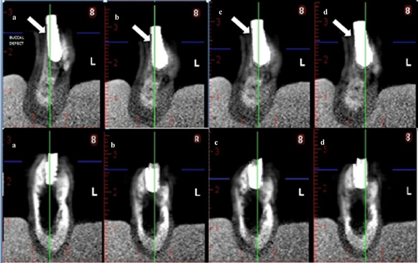 Measuring Defects on CBCT