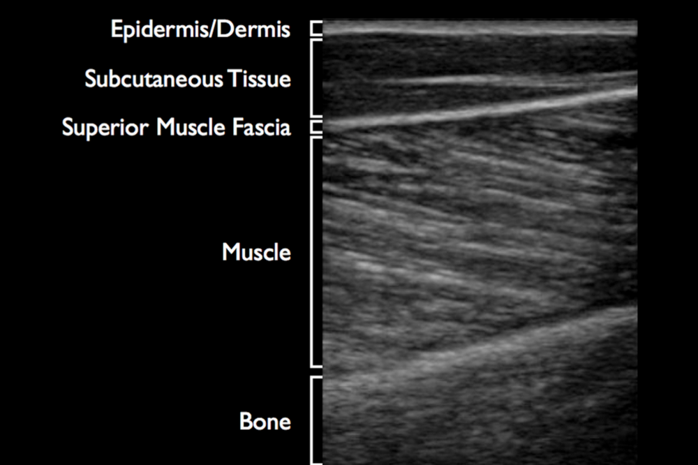 Tissue Imaging With Musculoskeletal Ultrasound