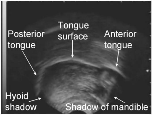 Figure 6. An Ultrasound Image of the Tongue