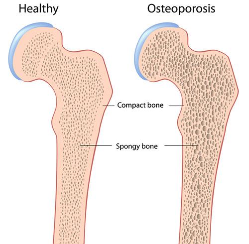 Management of osteoporosis in AS