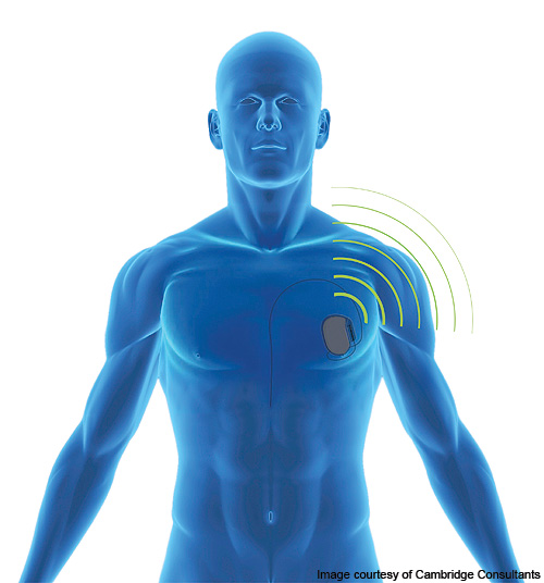 Introduction To Wireless Medical Implants