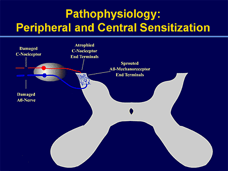 Peripheral and Central Sensitization