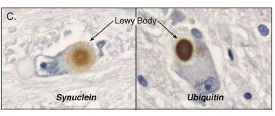 FIGURE 2. Lewy bodies in Substantia Niagara