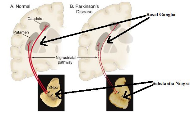 FIGURE 1. Comparison of normal brain and a brain of patient suffering from PD