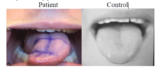 Figure 1. Control tongue during protrusion does not deviate