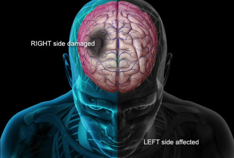How cortical stroke affects the body. If the right motor cortex is damaged, the left side of the body will be affected and vice-versa.