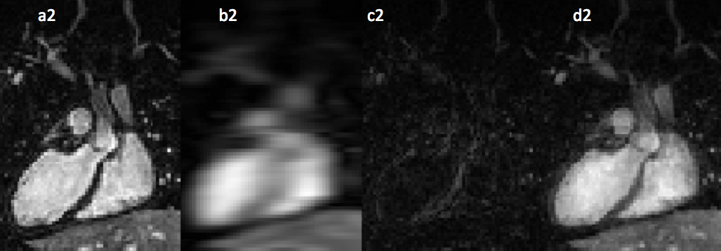 Figure 2: Image resolution is determined by the extent of the k-space that is covered. Top row represents the pattern chosen for image reconstruction (a1,b1,c1,d1): a1 represents the fully sampled k-space which is standard throughout all Phillips machine; a2 is the achieved cardiac image when the corresponding k5 space is reconstructed; b1 represents the k-space that is only sampled in the center; b2 is the reconstructed image and it can be seen that the center is extremely important in the contrast of the images; c1 represents the peripheral portion of the k-space sampled, as seen in c2 the peripheral of k-space contributes to the resolution of the image; d1 represents the uniformly undersampled k-space data which will be later reconstructed with a reconstruction algorithm, the original reconstruction will be d2.