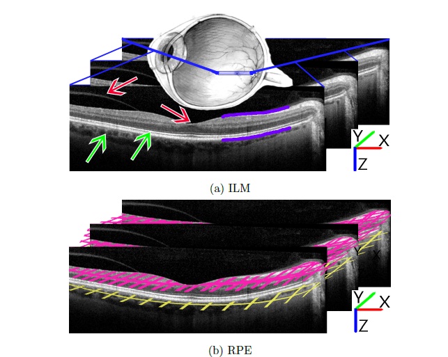 Figure 1.1.: Three sequential images taken from within an SD-OCT image stack of the human retina. Note Cartesian axes for future reference. (a) Purple lines denote the two layers of interest to be segmented: inner-limiting membrane (ILM) above, retinal pigmented epithelium (RPE) below. In a completely segmented image, the lines would extend along the layers in both directions. Red arrows indicate potential diculties for the ILM: vitreous artifact at left presents an area of continuous contrast similar to the ILM; topological dip at the foveola is often accompanied by a reduction in absolute contrast, making a concrete measure of contrast impractical. Green arrows indicate potential issues for the RPE: both the choroid (left) and inner/outer photoreceptor segment junction provide areas of contrast similar to that of the RPE. (b) Two lightly- colored grids demonstrate the nal desired result for a 3D segmentation of the two layers.